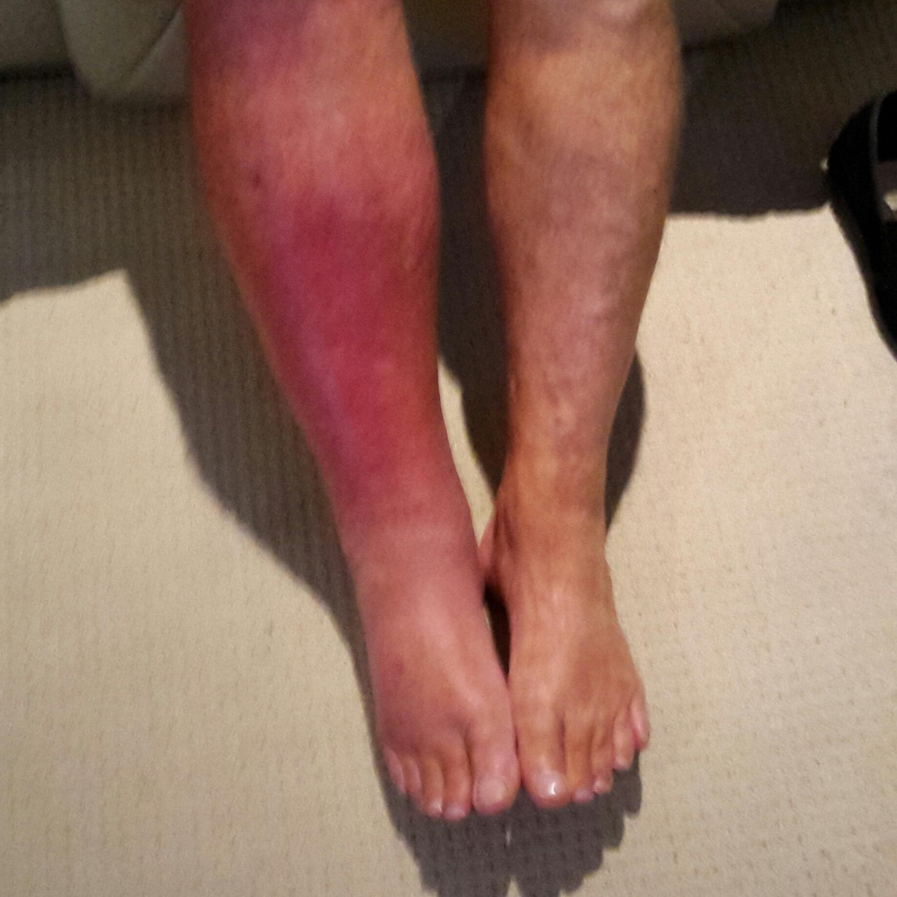 Collection 93+ Images pictures of cellulitis on legs Updated