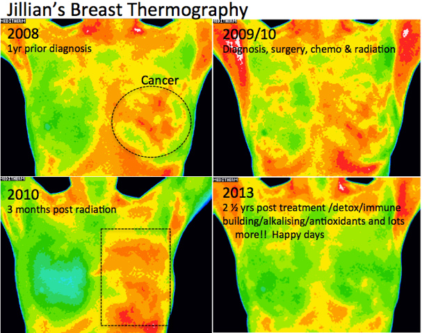 Jillian's Breast Thermography